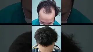 Hair Transplant at Divine | Natural Hair Transplant Result #shortsfeed