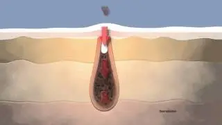 OXY Benzoyl Peroxide Animation