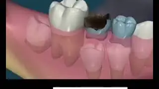 Importance of Milk / Deciduous teeth