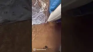ஸ்ட்ரெட்ச் மார்க்குக்கு இந்த மாதிரி சிகிச்சை இருக்கிறதா? #stretchmarks #weightloss #cupping #weight