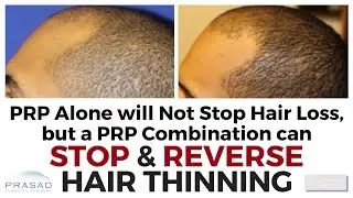 Improving Hair Loss Treatment with a One-Time PRP Combination that Lasts Years