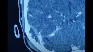 Intracranial abscess - Otomastoiditis complication in an adult female