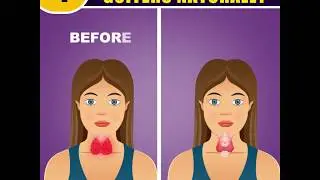 4  Easy Ways to Shrink Goiter Naturally