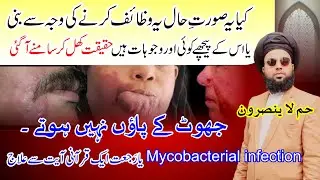 Ha Meem La Yunsaroon ki Rajat ya Mycobacterial Infection | Wazaif ki Haqeeqat | Peer Abu Numan Rizvi