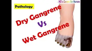 Difference between Dry gangrene and Wet gangrene।। Dry Gangrene Vs Wet Gangrene ।। Pathology।।