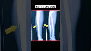 Fracture Ulna Bone #xray #fracture #shorts