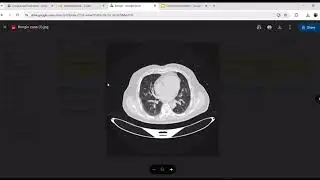 Lung cancer detection -Madhavi 
