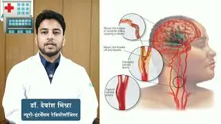 #cva #stroke #strokesurvivor #strokelife #stroketreatment #strokesupport #drabhishekshukla #cloth