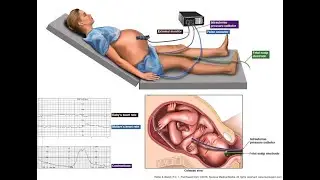 Fetal Monitoring Documentation; ensuring safe labor management, timely interventions