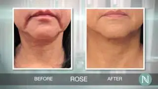 Before & After Nerium