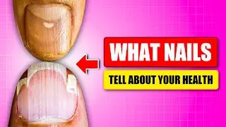 Shocking Truth: Nail Health Warning Signals