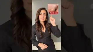 Blackheads, whiteheads, acne dark spots, open pores | dermatologist suggests