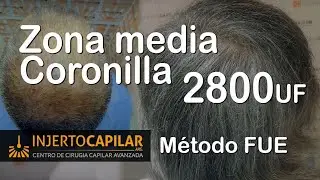 Trasplante Capilar por técnica FUE : 2800 Uf