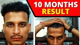 Ayushman 10 Month Hair Transplant Result Video