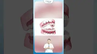 Trồng Răng Implant To&agrave;n H&agrave;m C&oacute; Phải Trồng Nhiều Trụ Mới L&agrave; Tốt? | Nha Khoa Minh Ch&acirc;u