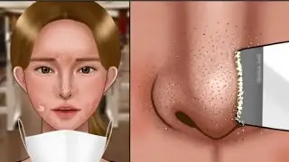 ASMR Satisfying Nose Blackheads & Sebum Extrusion Animation‼️ Sebaceous Cysts Inside the Mask, acne