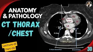 CT Chest or Thorax Anatomy-Lecture:16 (Part-02) | Tutorial-30 | Lower Chest |Lung |Chest Pathology |