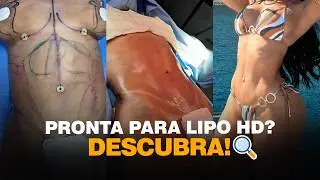 Lipoaspira&ccedil;&atilde;o HD: Peso Ideal para Lipo HD? A Verdade Sobre o Peso Ideal Lipo HD | Dr. &Iacute;caro Samuel
