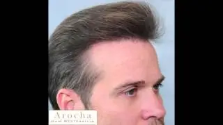 FUE Journey  Complete 1 Year