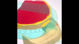 Complete denture design
