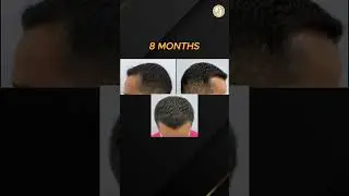 A stunning difference!  #baldnesssolution #fuehairtransplant #smartfue #fue #hairloss #hair