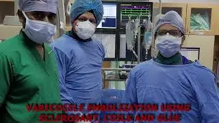Varicocele embolization using sclerosant, coils and glue