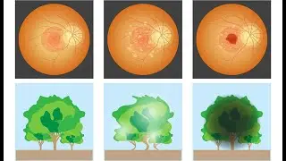 Treatment of Retinal Macular Degeneration. Treatment of retinal dystrophy