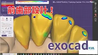 #044　exocad設計　前歯部4本ブリッジ（解説なし版）
