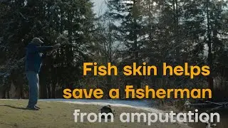 Kerecis Fish Skin Grafts Helps Save a Fisherman From Amputation | Success Story
