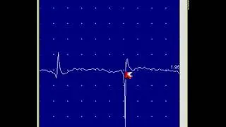 V2 - EMG Online Series: Power line frequency interference