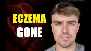 Greg’s Carnivore Transformation: From Lifelong Eczema to Clear Skin