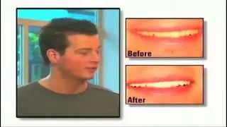 Dental Implants and Fillings Patient Edmonton