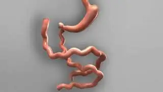 How Duodenal Switch Surgery is Performed