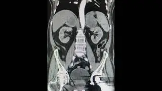 Bilateral Adrenal Adenomas #radiology #ctscan #radiologystudent