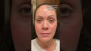 My results after using Dermatica for 3 months...