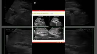 Ultrasound Pathology for Ultrasound | Liver Ultrasound Explained | جگر کا الٹراساؤنڈLiver 