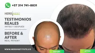 Implante capilar antes y después | RESULTADOS REALES | Paciente Real