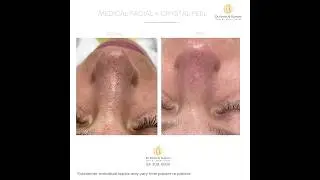 Crystal Peel at Dr. Kamil Al Rustom Skin and Laser Centre