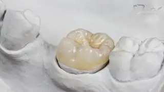 Dental Crowns and Bridges in Bury, Manchester