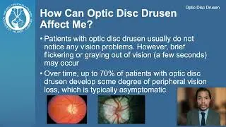 Optic Disc Drusen