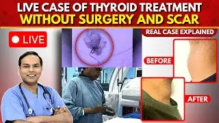 Scar कहाँ है? Thyroid Goiter Treatment Without Surgery | Dr Arun Gupta