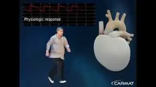 CARMAT Artificial Heart A Technological Prowess