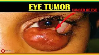 EYE TUMORS | CANCER OF EYE | BENIGN & MALIGNANT TUMORS OF EYE | TREATMENT OF EYE TUMORS