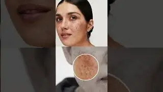 Skinlite cream ke fayde | skinlite cream use in Hindi | गोरे होने सबसे अच्छी क्रीम #shorts #skinlite