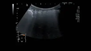 Stool impaction
