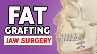 Fat Grafting in Jaw Surgery | Enhancing Results in Orthognathic Procedures