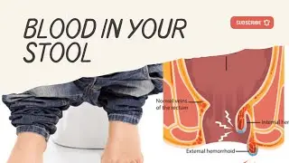 How We Will Control Bleeding From Rectum | Blood In Stool | Causes And Treatment ||