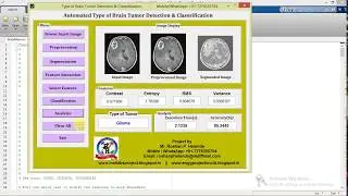 Matlab Code for Brain Tumor Types Detection and Classification Using Image Processing