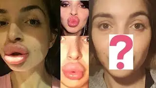 I DISSOLVED MY BOTCHED LIPS 6 TIMES!!
