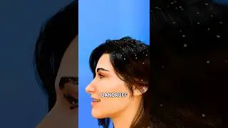Что на самом деле вызывает перхоть? 🤔